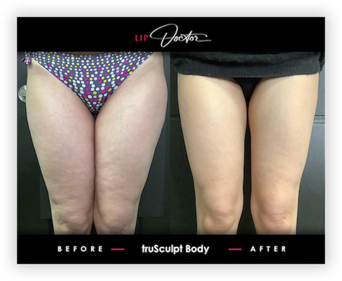 truSculpt® iD Before After Results 2